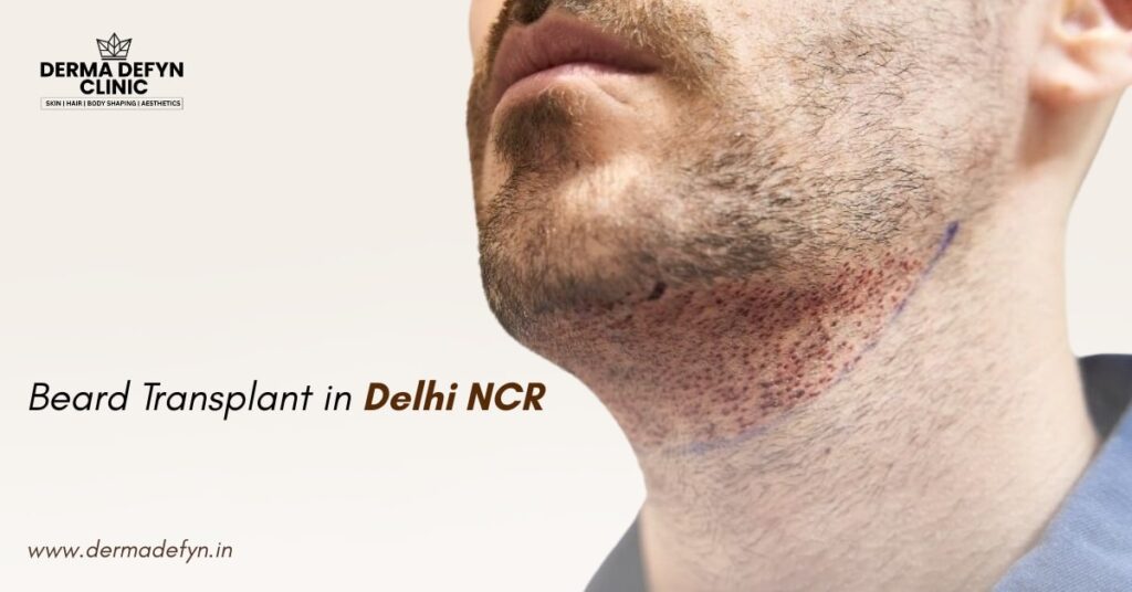 Beard Transplant in Delhi: Complete Guide to Natural Facial Hair Restoration