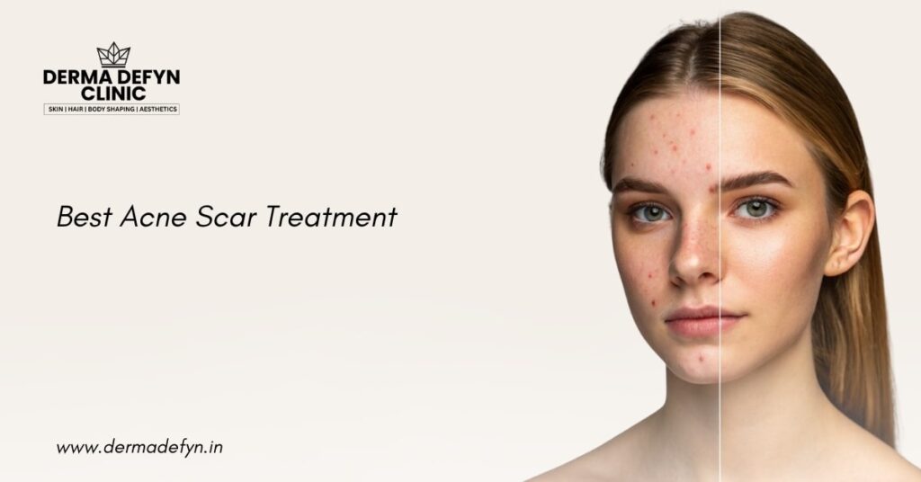 Acne Scar Treatment in Delhi NCR | Derma Defyn Skin Clinic