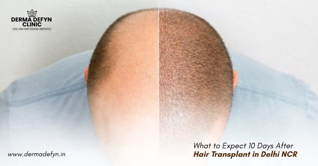 What to Expect 10 Days After Hair Transplant in Delhi NCR