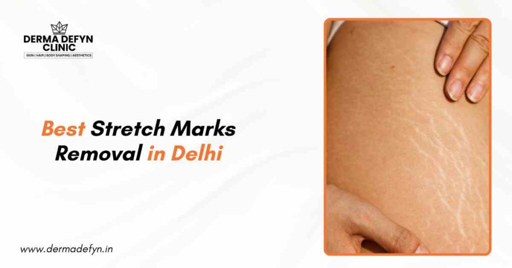 Best Stretch Marks Removal in Delhi